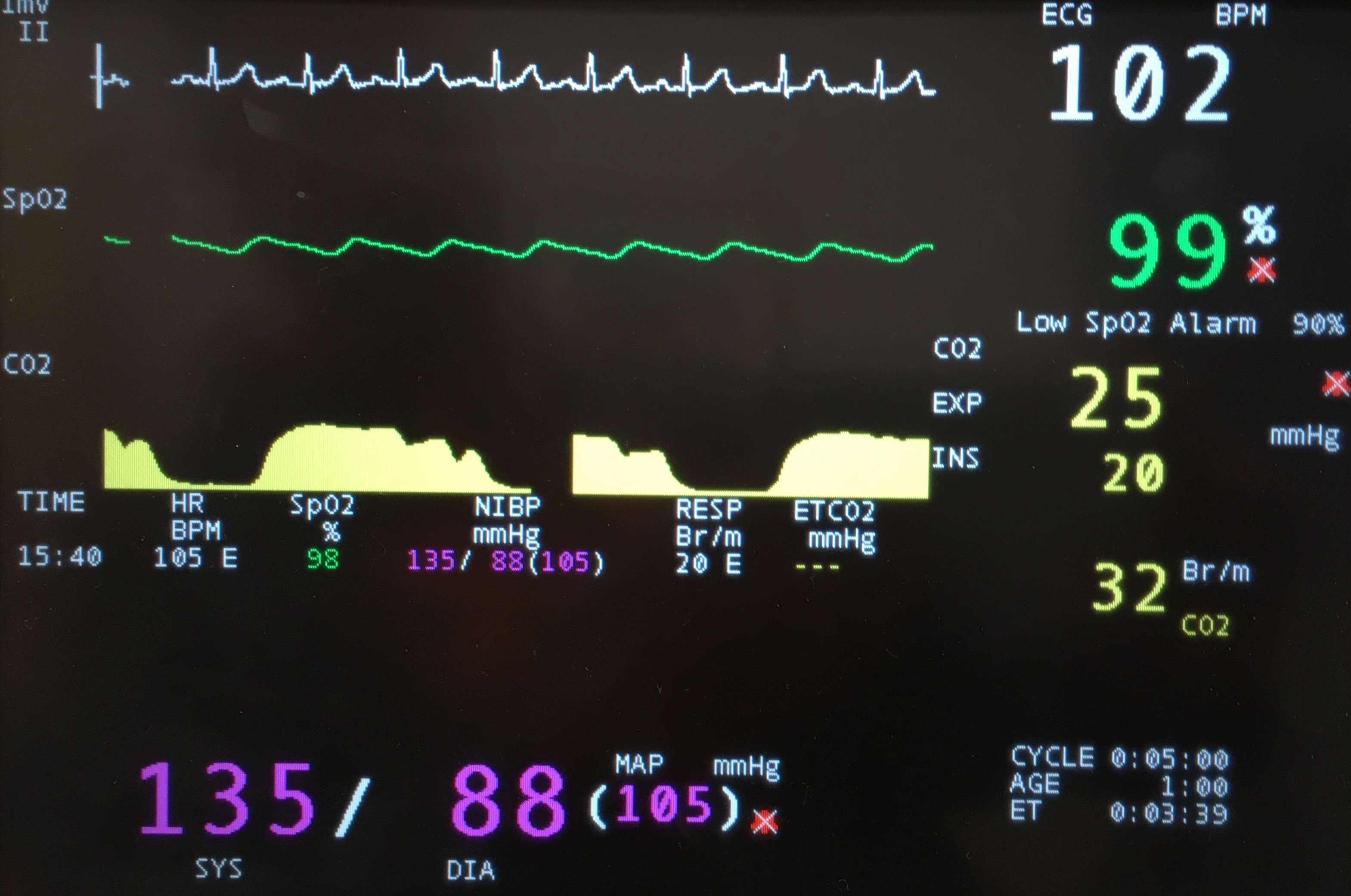 Monitor for sedation anesthesia Littleton, CO